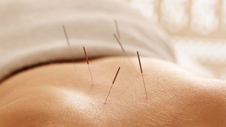 What is Acupuncture and How it Can Help You 