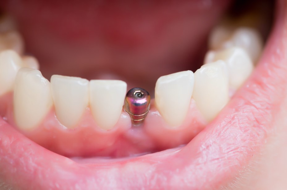 Dental Implants Costs in Brisbane vs Sydney